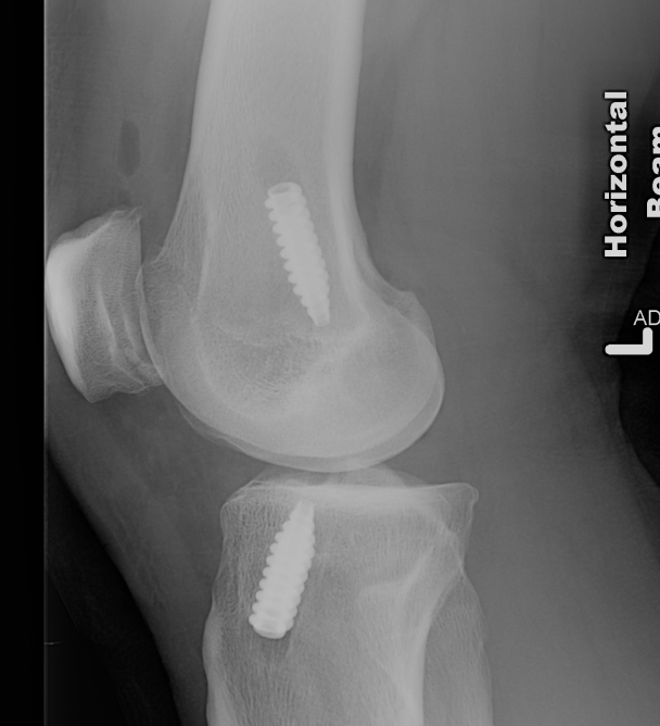 Lars ACL Post Op Xray Lateral